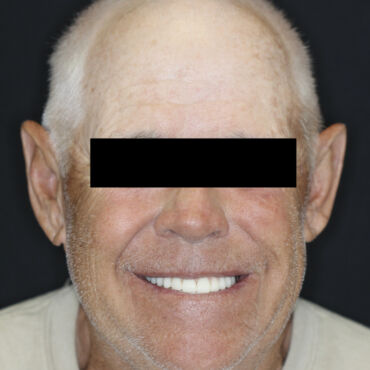 Dental Implants in Lake Wales, FL